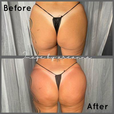 Noninvasive butt lift using body contouring