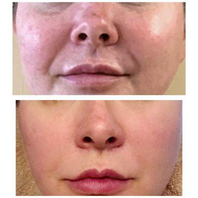 Before and after a series of rosacea redness laser facials.