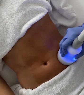 Cryoskin body Contouring