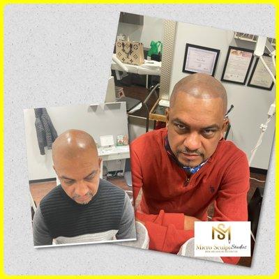 Scalp micropigmentation