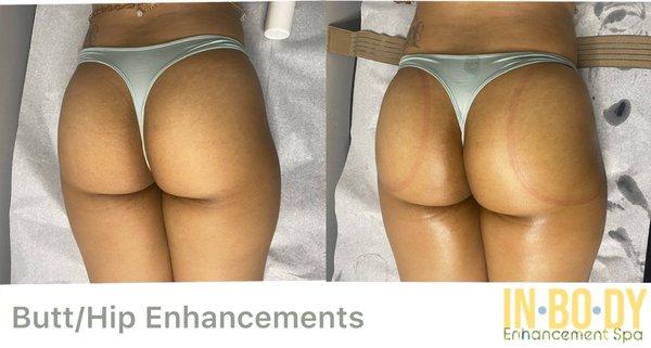 Hip/Butt Enhacements