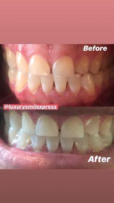 Before and after done by Luxury Smile Xpress.