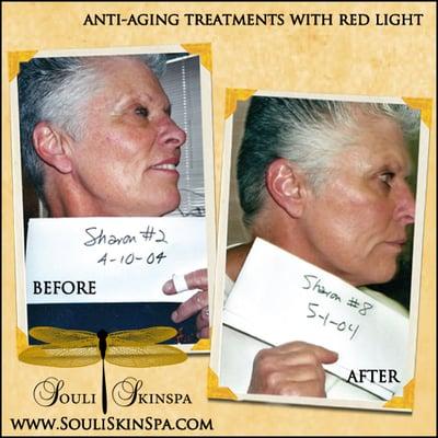 anti-aging light therapy