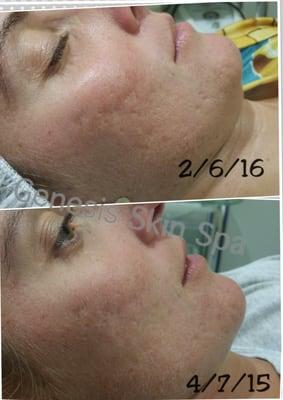 Acne Scarring treatment with Micropen ( Collagen Induction Therapy )