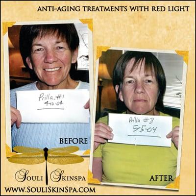 anti-aging light therapy