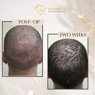 Celebrity Hair Restoration