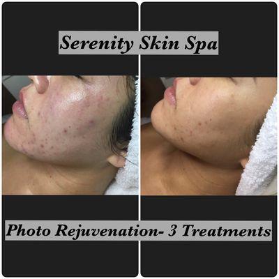 Skin Transformation!  Reduced her acne and acne scars with the Acne Purifying Facial, Microdermabrasion, Light Peel and Photo Rejuvenation