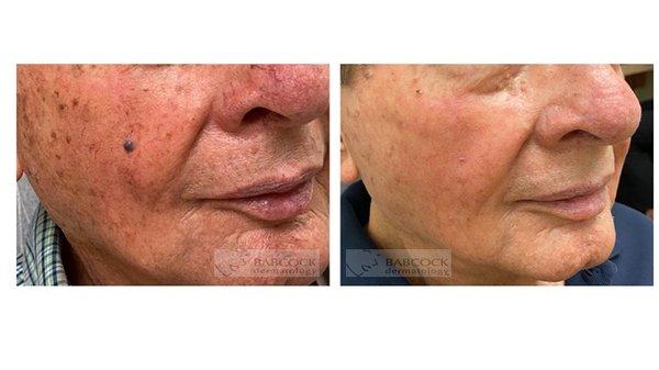 Icon Laser to treat brown and red spots