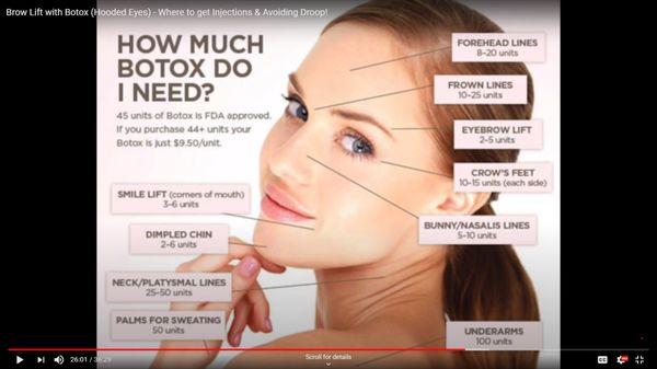 Thinking about how much Botox you might need?