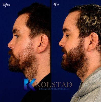 beard transplant