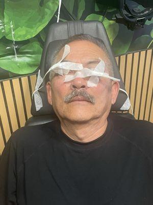 Me, undergoing the lipflow thermal pulsation treatment. It was like a miracle.