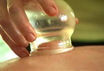 Cupping Therapy