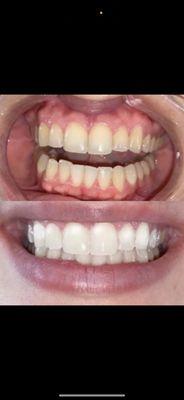 Cosmetic Teeth Whitening                                            4-8 shades ONE-HOUR minimal sensitivity