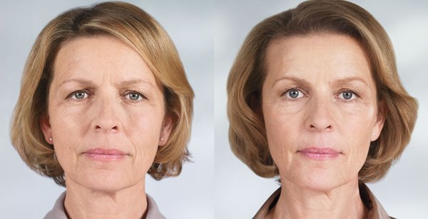 Sculptra Before/After