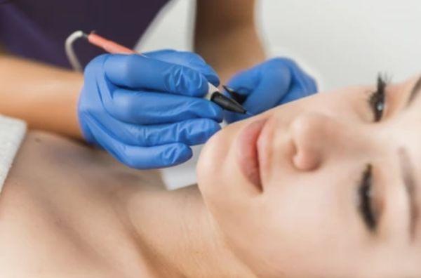 Electrolysis modalities include galvanic, thermolysis, and blend.