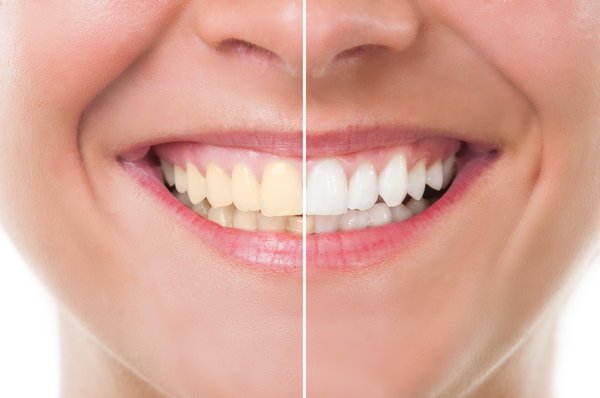 Whitening Before and After