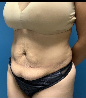 Before abdominoplasty