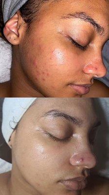 Acné facial