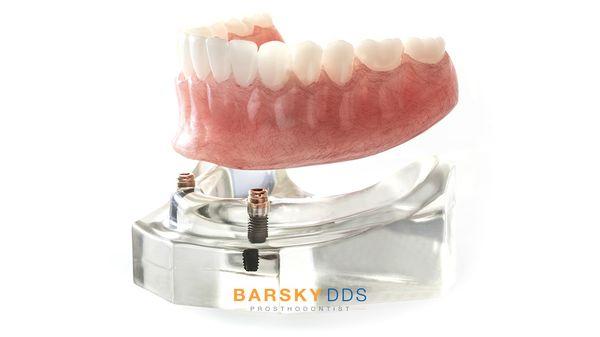 Dental Implants at Barsky DDS