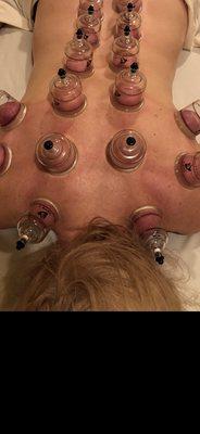 Cupping $40