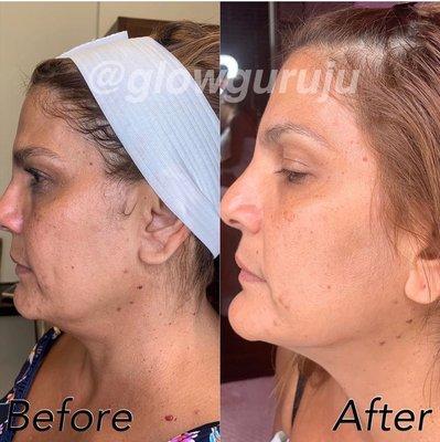 Face tightening