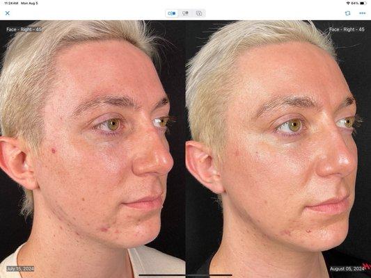 Results following a Halo laser treatment (full results in a few months after treatment)