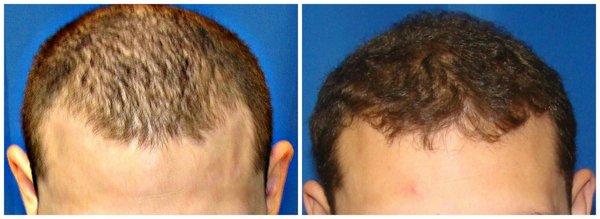 25-34 year old man treated with Hair Transplant