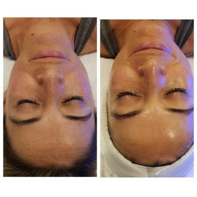 Deluxe HydraFacial