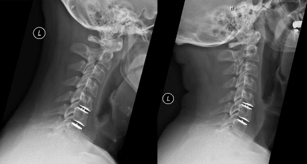 2 level cervical disc replacement