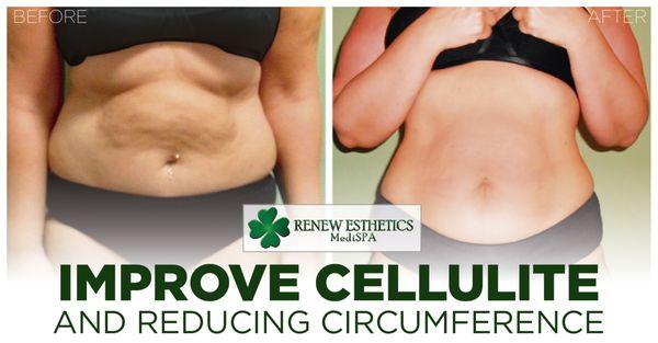 Amazing results #BodyTreatments * FREE INITIAL Call us : (718)2040458 CONSULTATION * http://ow.ly/3OiP309YZge