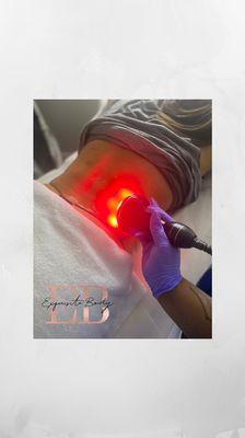 Ultrasound Cavitation and radio Frequency to break down fat cells on back fat.