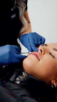 Lip filler treatment at myEvergreen Medspa