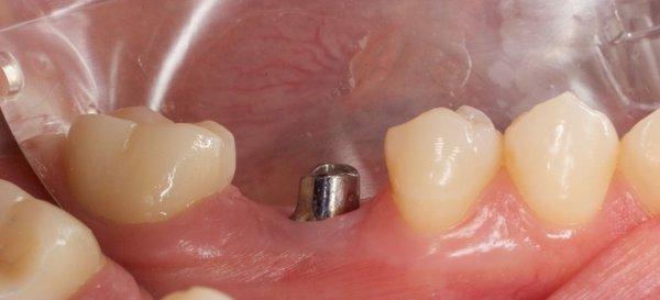 Dental implant