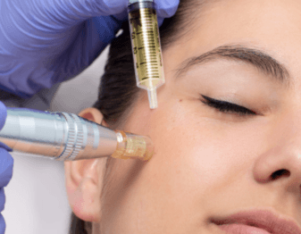 Microneedling