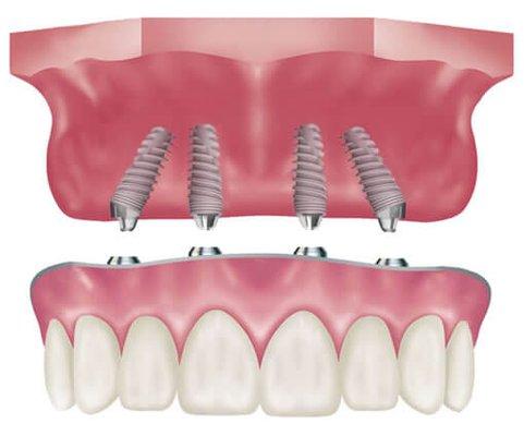 All on 4--  Dental implants done at our office by our Surgical & restorative team.