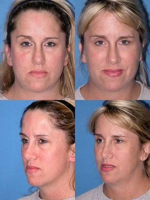 Blepharoplasty - Eyelid Surgery before and after photo