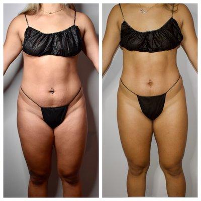 She already had abs, we just enhanced them!
 
 Before and after just 1 session!