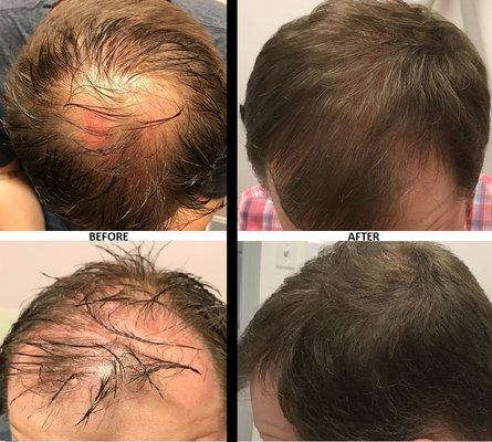 PRP Hair Restoration- 3 Sessions