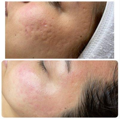 Microneedling for acne scars. More sessions to go, but very pleased with her progress!