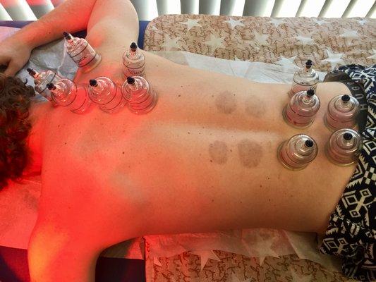 Cupping Therapy