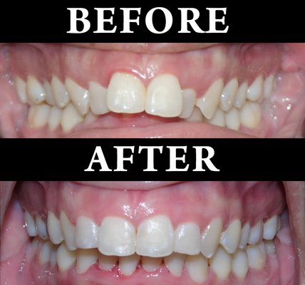 Invisalign Before and After