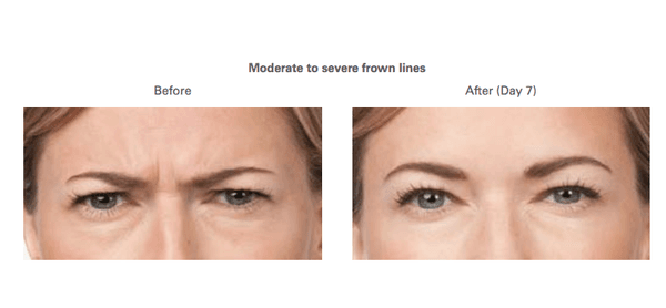 Botox for Forehead lines, II's, and Smile lines