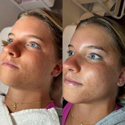 Before/After: Dermaplaning Facial