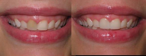 Veneer and Teeth Whitening Woodbury, Mn