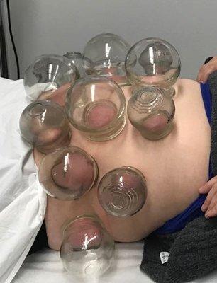 Cupping treatment