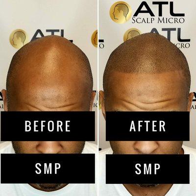 Before and After Scalp Micropigmentation Black Men Atlanta at ATL Scalp Micro