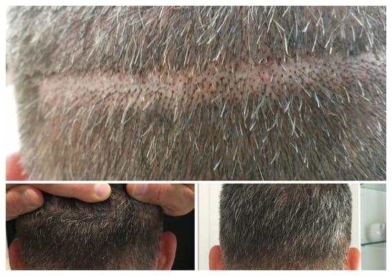 scalp scar using smp technique to cover up.