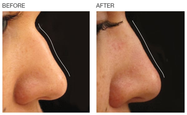 Nose contouring. Actual patient of Dr. Bracci. Unretouched photo.