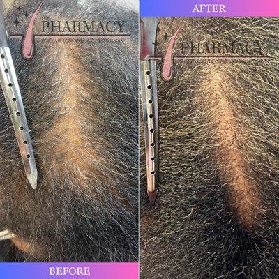 Hair Loss Treatment - Before & After