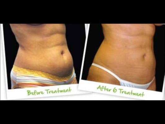 Nonsurgical Lipo & Skin Tightening Center